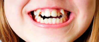 У ребенка неправильный прикус – что делать и с какого возраста можно исправлять аномалии зубов